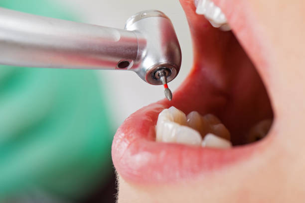 Best Dental Abscess Treatment in Painesville, OH